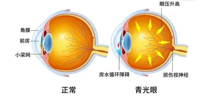 青光眼手术能彻底治愈吗