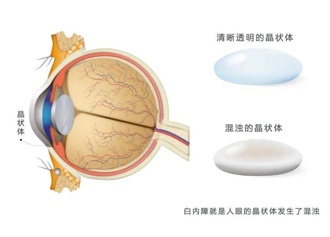 白内障是什么原因引起的