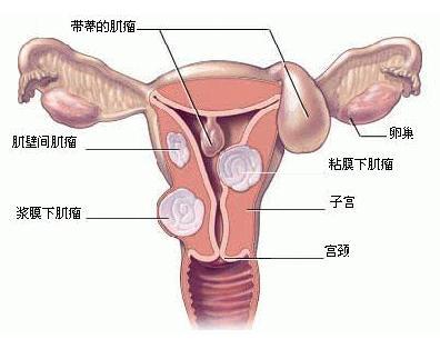 治疗子宫肌瘤的偏方