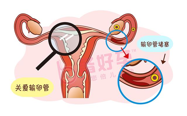 输卵管阻塞性不孕