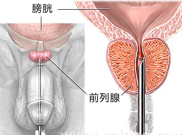 前列腺炎症的症状