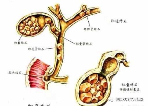 胆结石切除对身体有什么影响,胆结石切除对身体的影响及实践解析说明,精准分析实施步骤_MP28.21.77