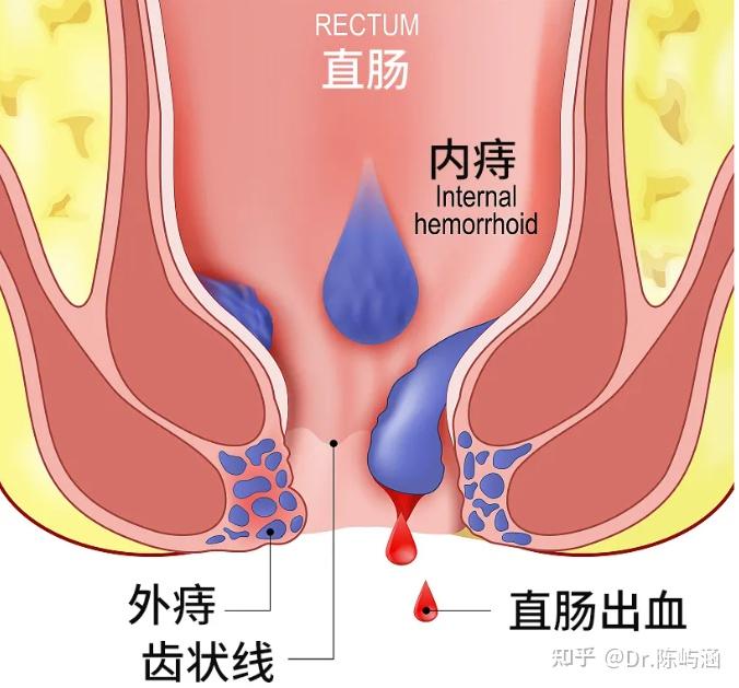 痔疮是什么样子的 早期,痔疮的早期形态解析与数据解析设计导向探究,深入解答解释定义_冒险版57.24.71