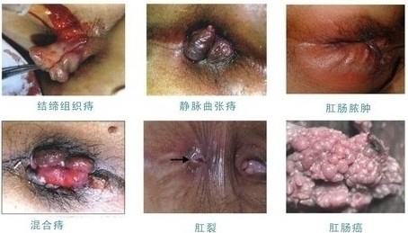 男子患痔疮喷血3个月致重度贫血